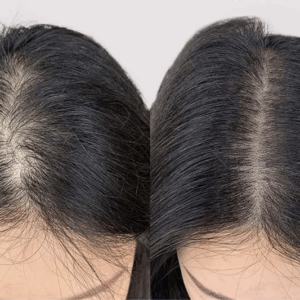 Scalp Pigmentation Class